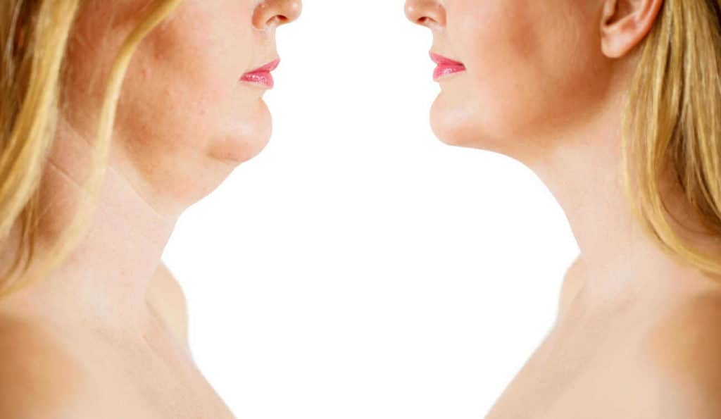 Double Chin treatment Uttoxeter before and after results