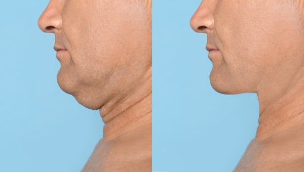 Which Non-Surgical Treatments Work Best for Jowls and Loose Skin Uttoxeter?