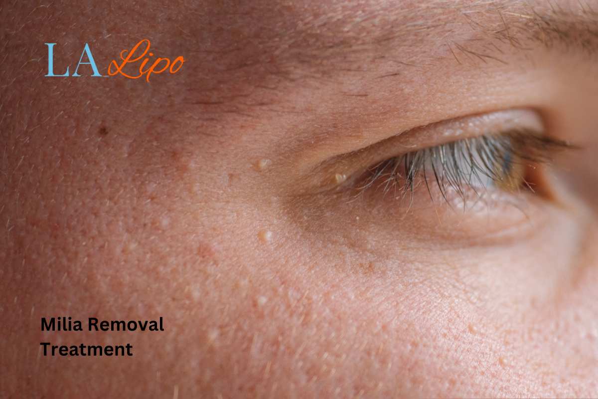 Cryopen Milia Removal: Is It the Easiest and Safest Option Uttoxeter?