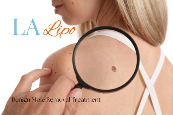 Woman having her inspection of blemish before mole removal Uttoxeter