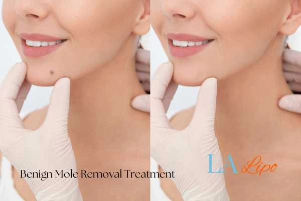 woman's before and after mole removal Uttoxeter results