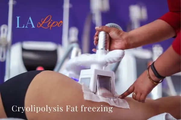 women getting fat freezing Uttoxeter