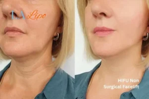 hi-fu for wrinkles Uttoxeter before and after results