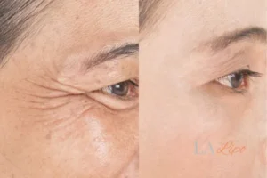 Before and after results of woman - HI-fu wrinkles reduction treatment Uttoxeter