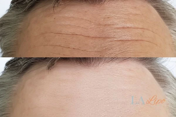 results of HIFU Uttoxeter on mans forehead to help reduce lines and wrinkles