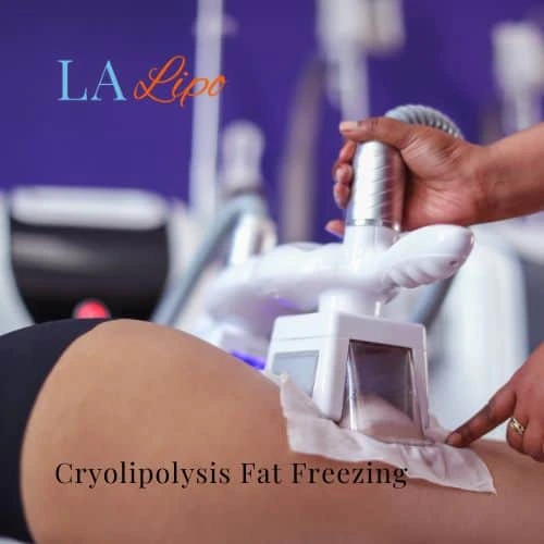 fat freezing - Cryolipolysis Uttoxeter