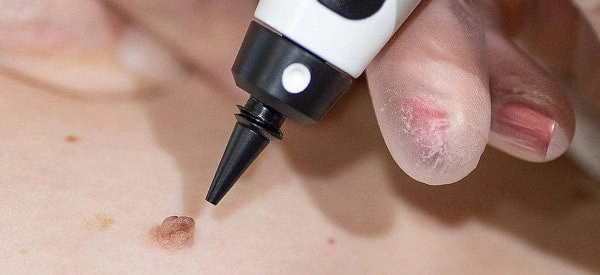 skin tag removal using cryopen Uttoxeter