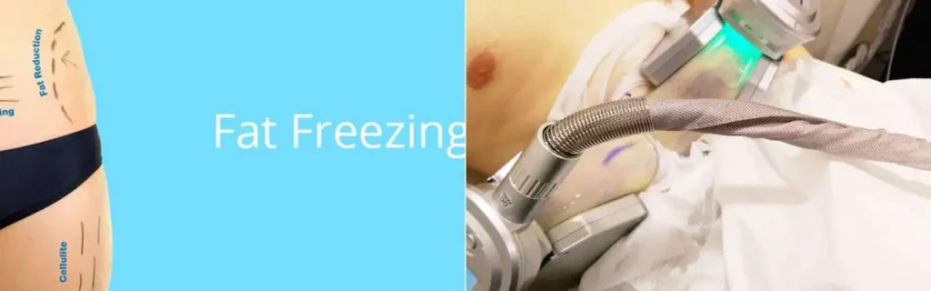 Fat freezing Uttoxeter on multiple areas of the body