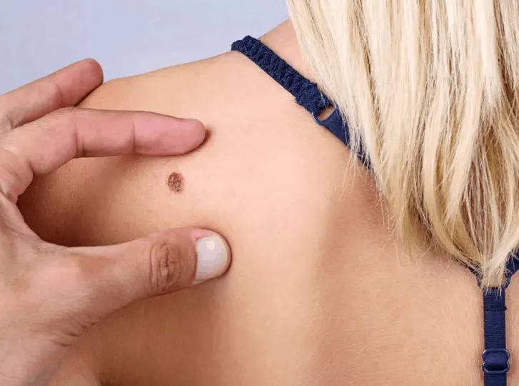 woman having mole removal Uttoxeter consultation before treatment.