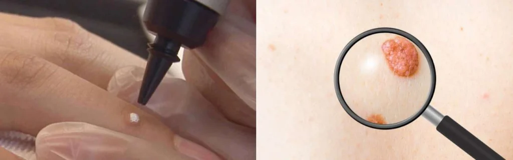 Person getting moles removed with cryopen Uttoxeter