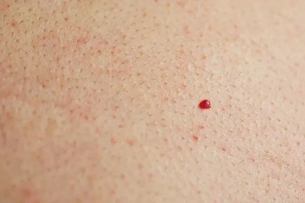 close up of a cherry angioma Uttoxeter