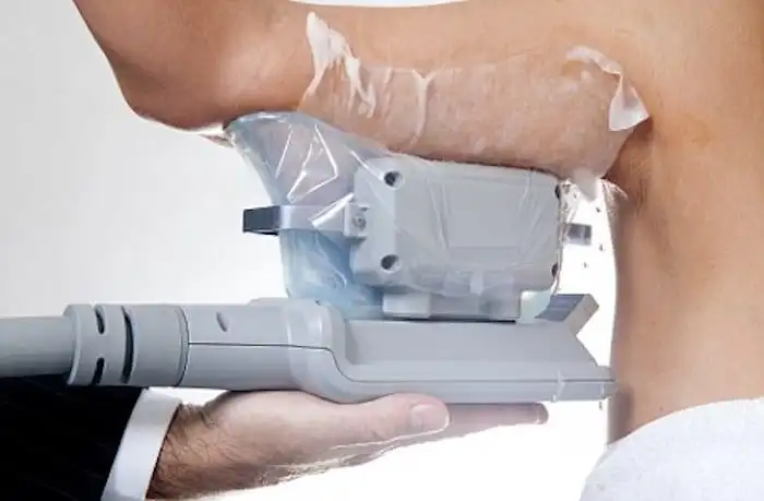 Picture of fat freezing Uttoxeter on the upper arms.