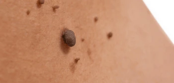 image of a skin tag Uttoxeter