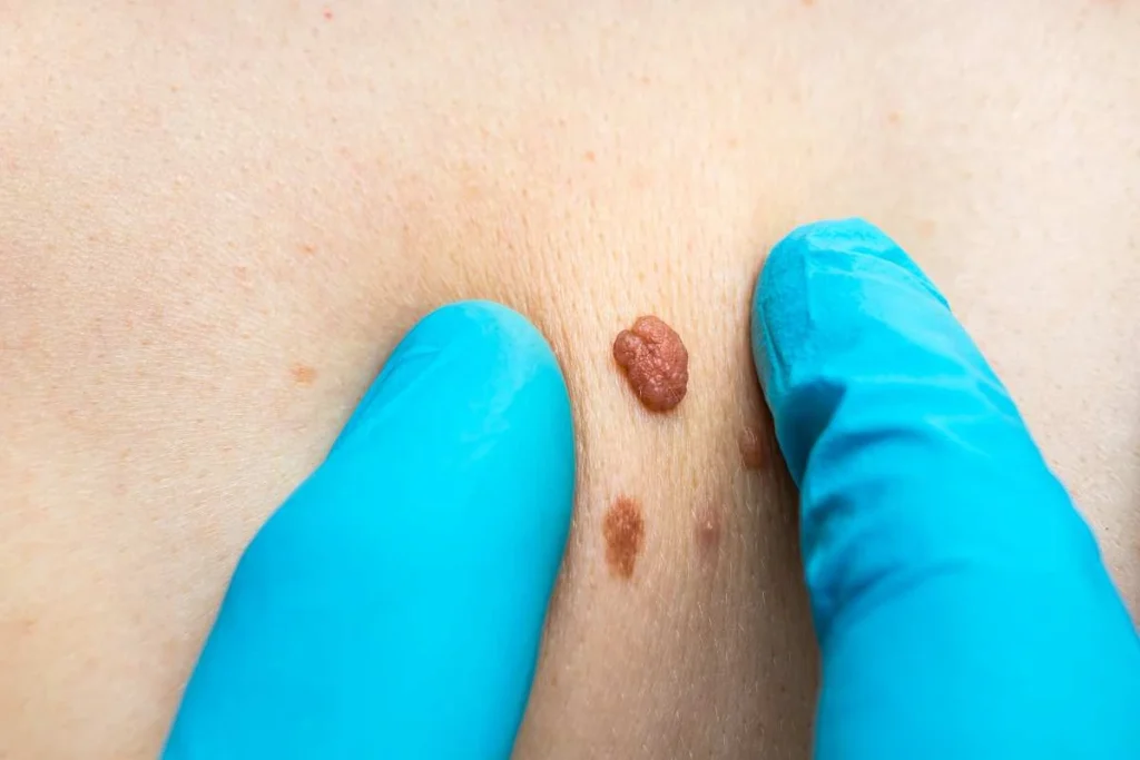 Consultant examining a skin tag Uttoxeter