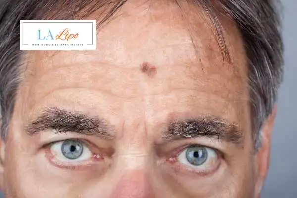 Solar Lentigo Removal Uttoxeter image of man with mark on his forehead