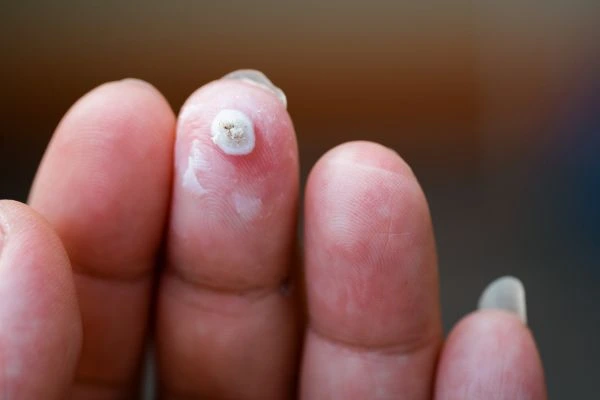wart on person finger - cryotherapy to treat from LA LIPO Uttoxeter