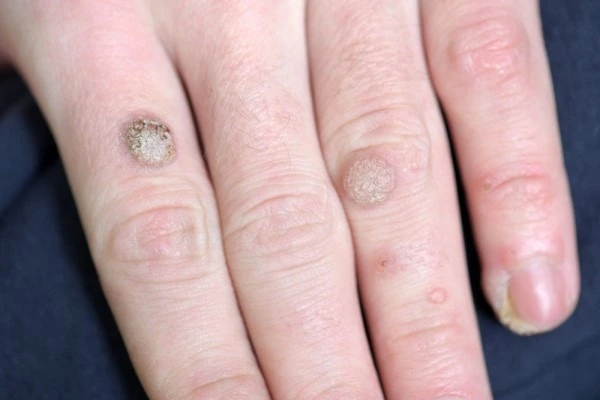 photo of warts on person hand - see wart removal Uttoxeter from LA LIPO