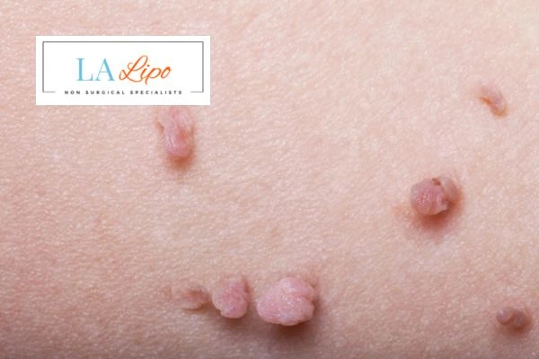 Does cryopen skin tag removal Uttoxeter hurt? Find out now call our team today!