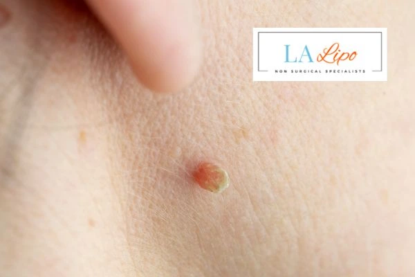 Book skin tag removal Uttoxeter today speak to our team now!