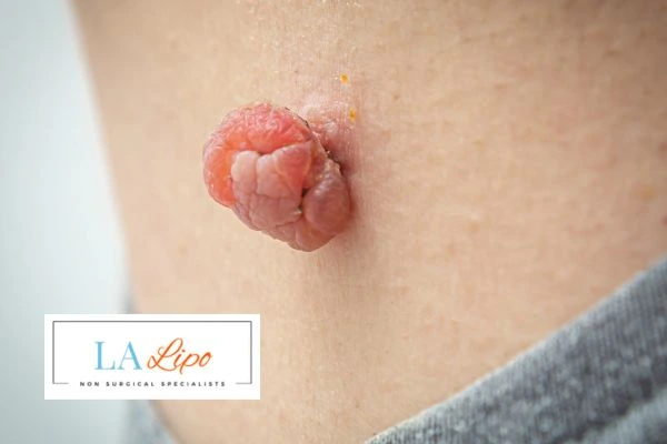 Interested in skin tag removal Uttoxeter? Concerned about the pain? Find out more today!