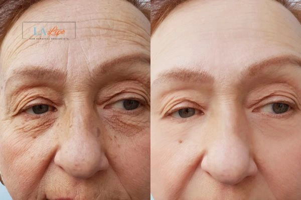 The powerful benefits of Morpheus8 Treatment Uttoxeter - Call Our team today!