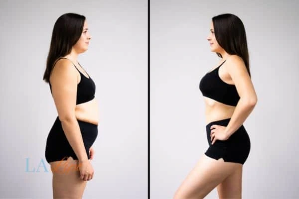 Picture of womans before and after using LA-EMS body sculpting to improve her core strength Uttoxeter