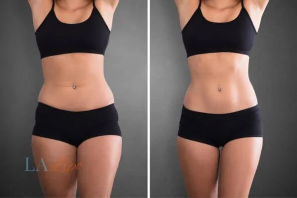before and after results of non-surgical treatment to help a woman's body image and mental health Uttoxeter