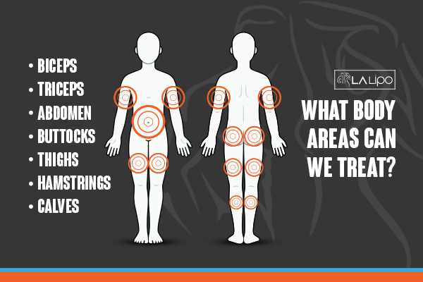 Diagram to show areas you can have LA-EMS Body Sculpting Treatment Uttoxeter