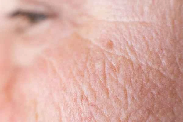 close up picture of a woman's face showing an age spot Uttoxeter