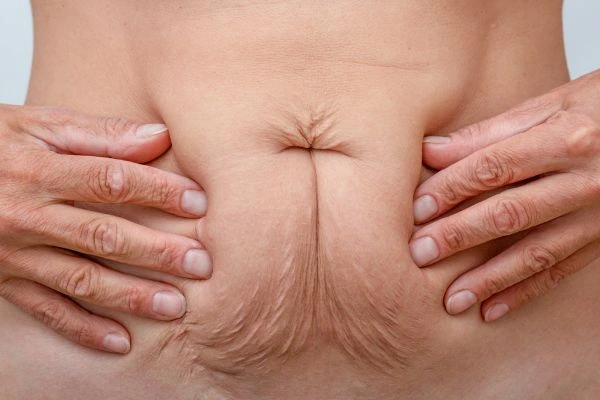 Image of a woman's stomach with loose skin - example of skin tightening Uttoxeter options